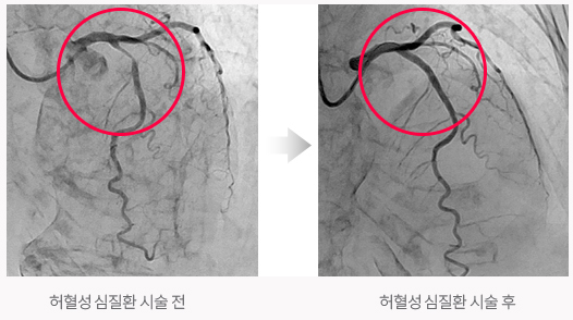 허혈성 심질환 시술전, 허혈성 심질환 시술후