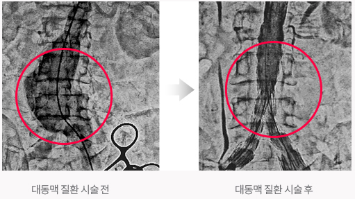 대동맥 질환 시술전, 대동맥 질환 시술후