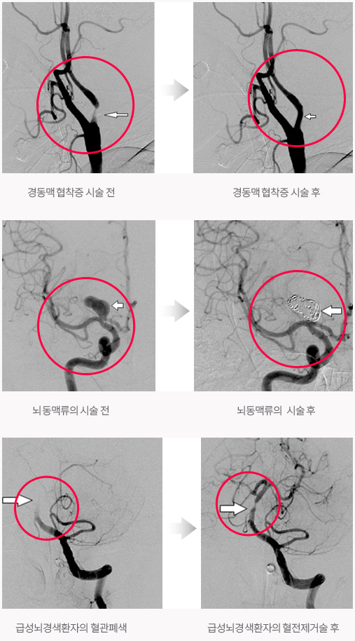 뇌혈관 중재시술