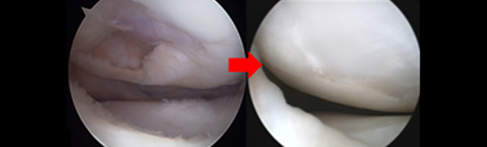 관절연골결손 → 관절연골재생