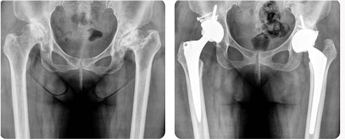 인공 고관절(엉덩이) 치환술이란?
