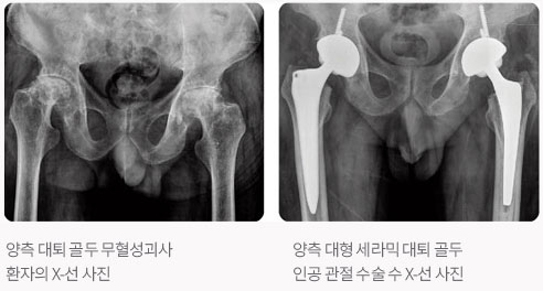 양측 대퇴 골두 무혈성괴사 환자의 X-선 사진, 양측 대형 세라믹 대퇴 골두 인공 관절 수술 수 X-선 사진