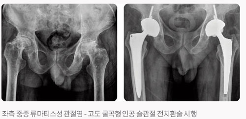 좌측 중증 류마티스성 관절염 - 고도 굴곡형 인공 슬관절 전치환술 시행
