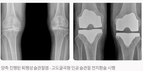 양측 진행된 퇴행성 슬관절염 - 고도굴곡형 인공 슬관절 전치환술 시행