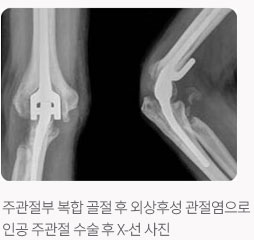 주관절부 복합 골절 후 외상후성 관절염으로 인공 주관절 수술 후 X-선 사진