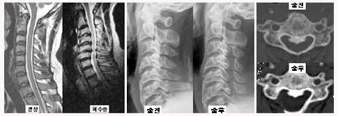 경추 척수증 후방 수술적 치료