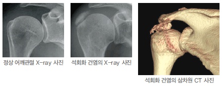정상 어깨관절 X-ray 사진, 석회화 건염의 X-ray 사진, 석히화 건염의 삼차원 CT사진