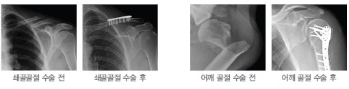 쇄골골절 수술 전, 쇄골골절 수술 후, 어깨 골절 수술 전, 어깨 골절 수술 후