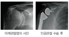 어깨관절염의 사진, 인공관절 수술 후