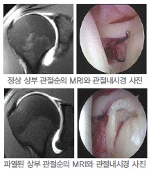 정상 상부 관절순의 MRI와 관절내시경 사진, 파열된 상부 관절순의 MRI와 관절내시경 사진